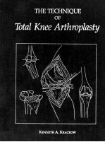 THE TECHNIQUE O<em>F</em> TOTAL KNEE ARTHROPLASTY